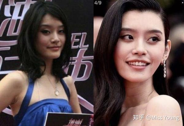 奚梦瑶整容前的照片,嘴角上方也有这条纹路.