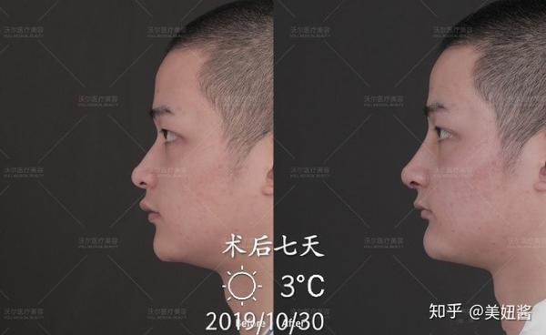 男生整容比女生更需要注意的点—男生隆鼻要自然,绝对不可以被人看