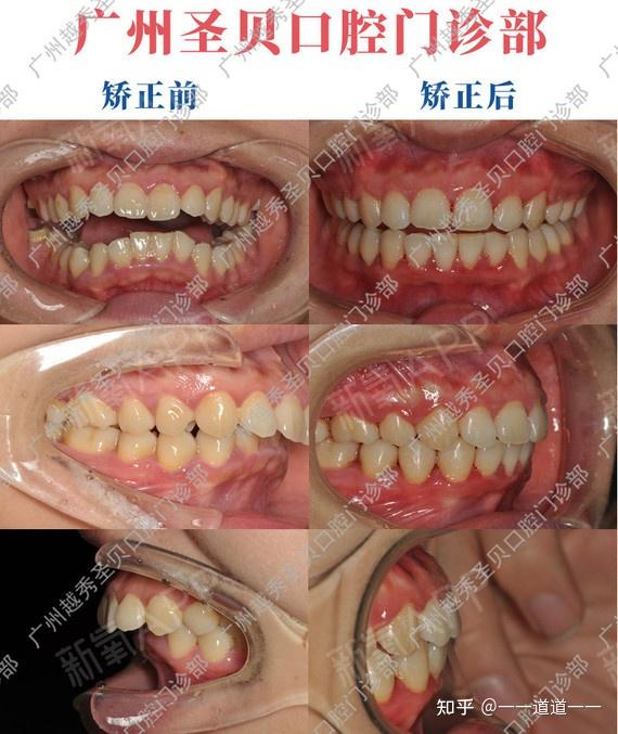 五:牙齿矫正前后口内情况