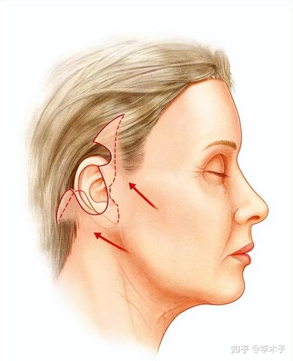 筋膜提拉术手术全过程筋膜提升术是什么原理看完就懂了 知乎