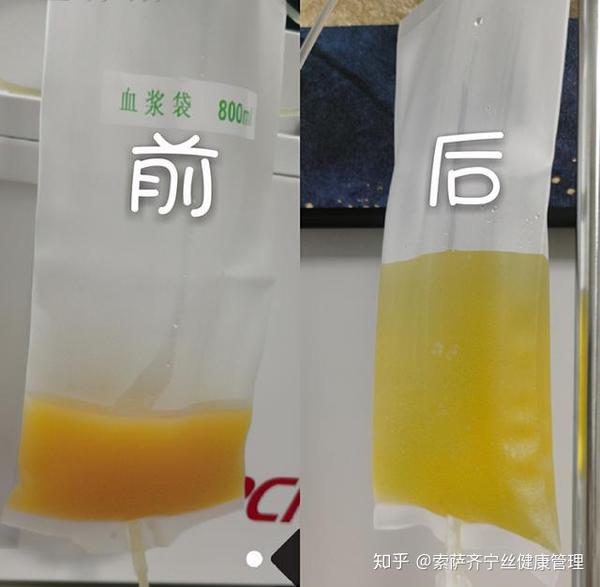 血浆净化前后对比