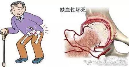 "髋痛"不一定都是"股骨头坏死"