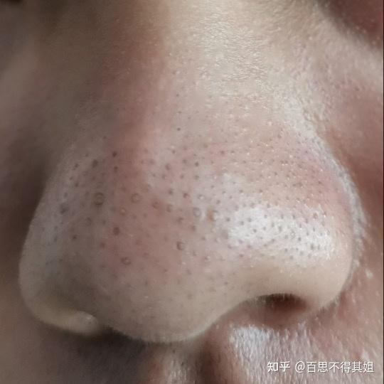 鼻子上挤出来的白色小颗粒是什么?