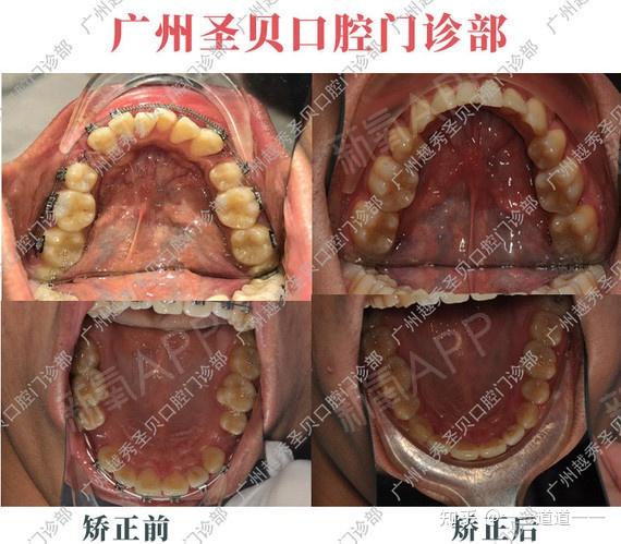广州圣贝蔡菁菁医生牙齿矫正案例分享:错颌畸形 双颌前突治疗