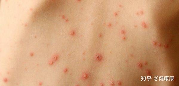 一项研究发现,每11名新冠肺炎确诊患者中便有一人出现皮肤红疹症状