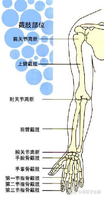 肩部截肢:尽可能保留肱骨头 上臂截肢:尽量保留残肢长度 肘部截肢:肘