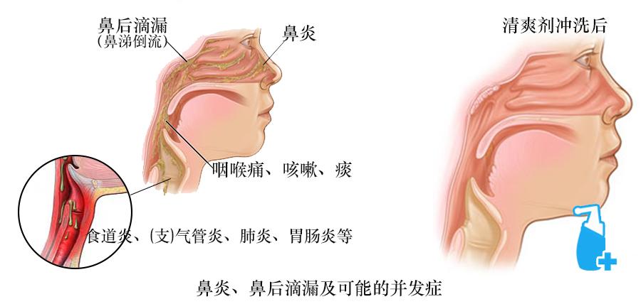 鼻腔及呼吸道健康  我的专注只为你的健康   本来想有时间了写一些