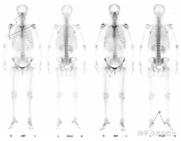 什么是全身骨扫描扫描辐射副作用大不大
