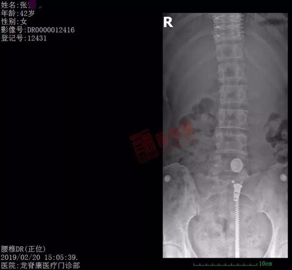 张女士骨盆x光片(图片来源龙脊康)