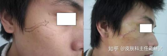 瘢痕的治疗(一)手术治疗
