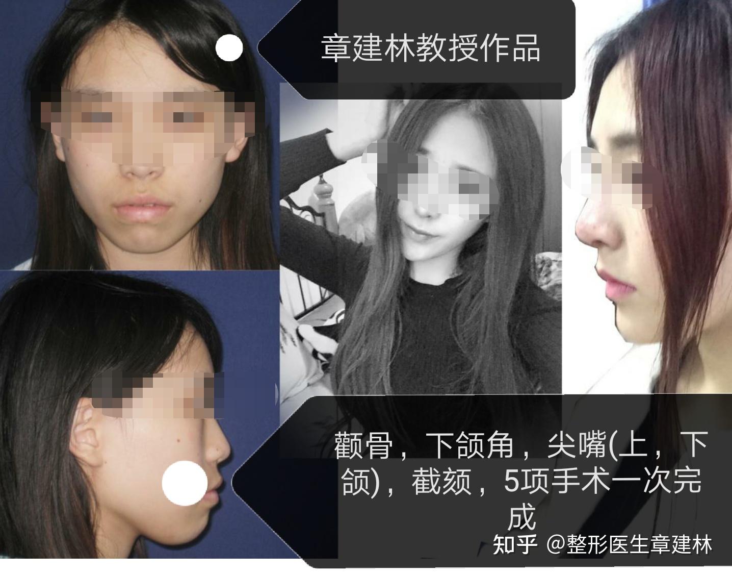 圆脸做完正颌手术后脸型会变好看吗
