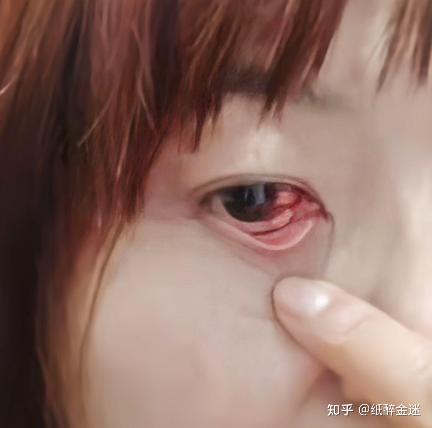 今天早上突然发现眼睛的眼白长了一个血块,是很严重吗