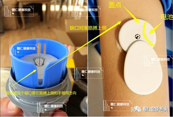 【雅培瞬感伴侣】旺旺发射器手机安装配置教程