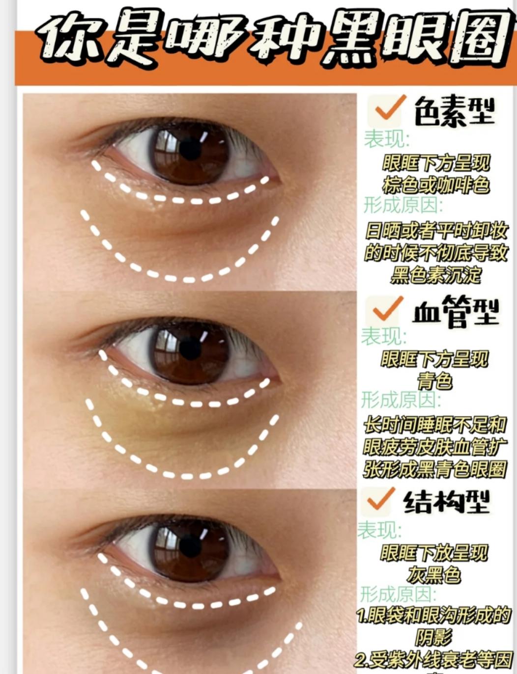 淡化黑眼圈类型辨别改善方法3步走全攻略