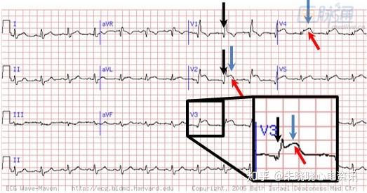 心肌梗死:不可错过的心电图线索