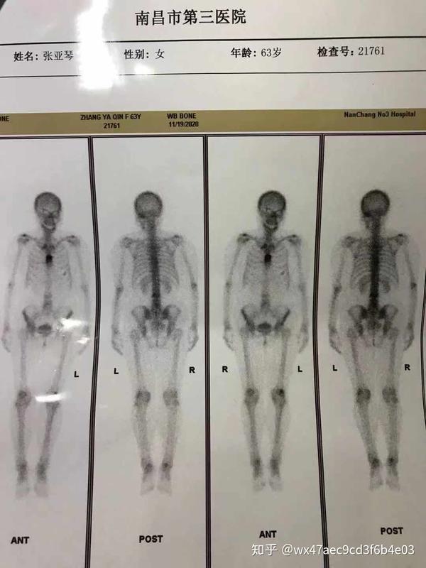 记录妈妈乳腺癌骨转移求医之路
