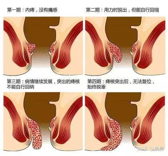 为什么说痔疮难治愈这些你知道多少