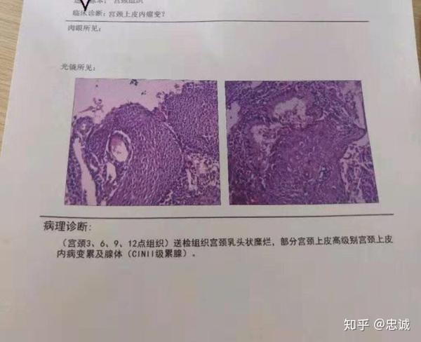 未婚未育,hpv52和58,cinii,准备年后宫颈锥切.