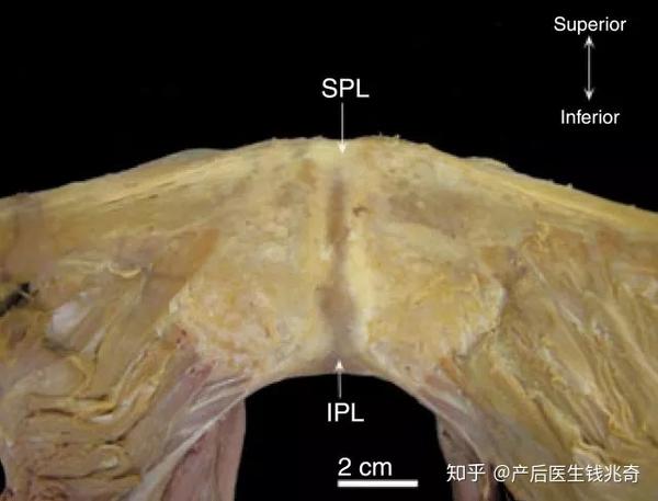 耻骨联合解剖图,spl为耻骨上韧带,ipl为耻骨下韧带(耻骨弓状韧带