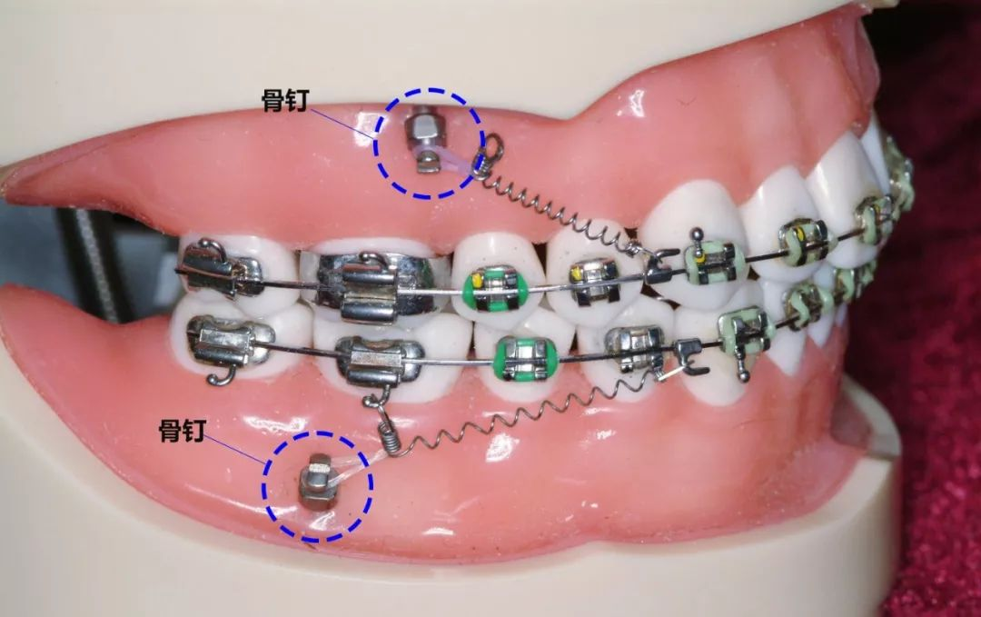 牙齿矫正中支抗钉的作用是什么