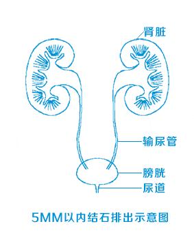 6厘米的结石可以自行排出,因为人体内输尿管的宽度在0.5~0.7厘米之间.