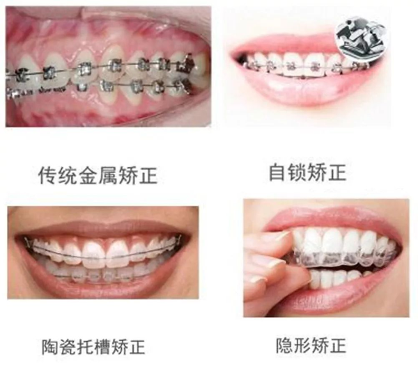 现在矫正牙齿的牙套种类有很多,比如钢丝牙套,透明隐形牙套,陶瓷牙套