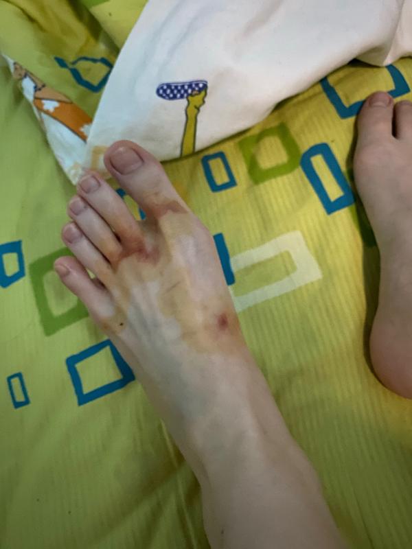浅二度热水烫伤恢复记录(持续更新