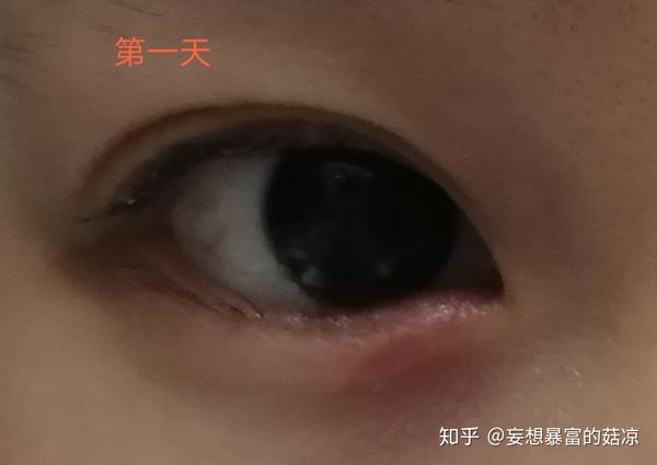 得了麦粒肿(撅眼)的过程?