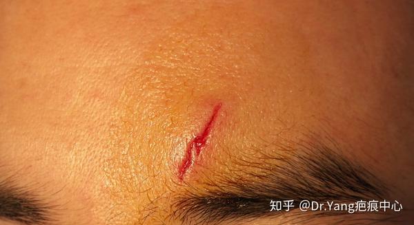 一例额部外伤美容缝合