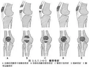 横断骨折与 粉碎骨折.