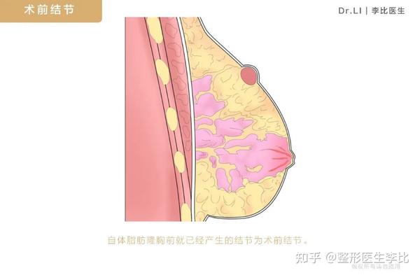 除了在自体脂肪丰胸前,自己本身胸部就有结节或自己术后护理不当造成