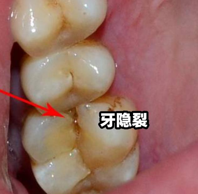 来保护牙齿; 但如果是牙隐裂的裂纹已经到达了牙根或是整个牙齿都已经