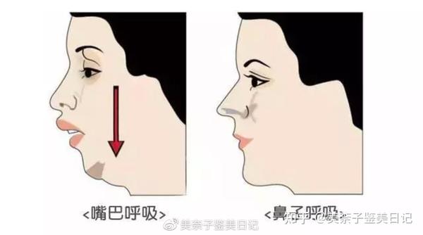 这张图就是明显的因为长时间口呼吸导致的下巴后缩,看着显的凸嘴 1.