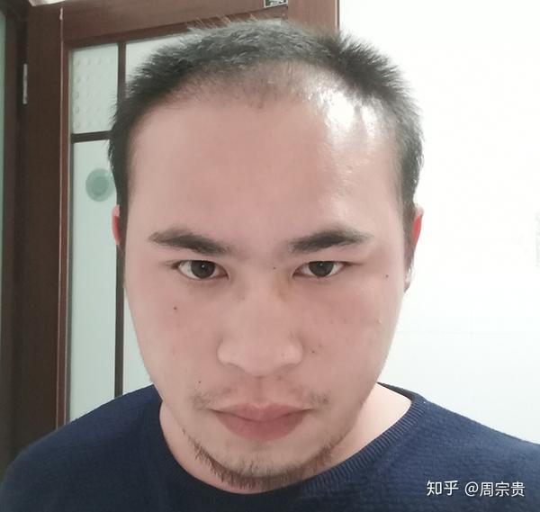 三级脱发2000单位,术后效果怎么样?