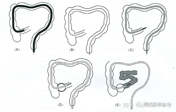 磁共振小肠成像