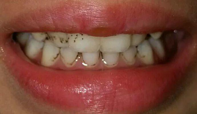孩子牙齿上的小黑点究竟是什么 松鼠牙医:好好刷牙就对了!