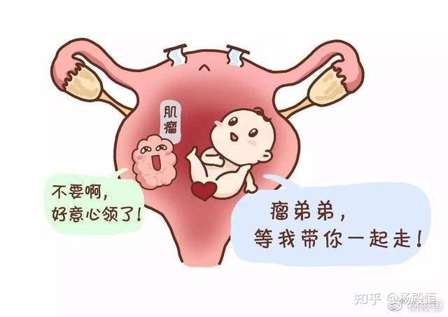 3,子宫肌瘤蒂扭转:怀孕合并浆膜下肌瘤时,随着子宫逐步增大,有蒂的