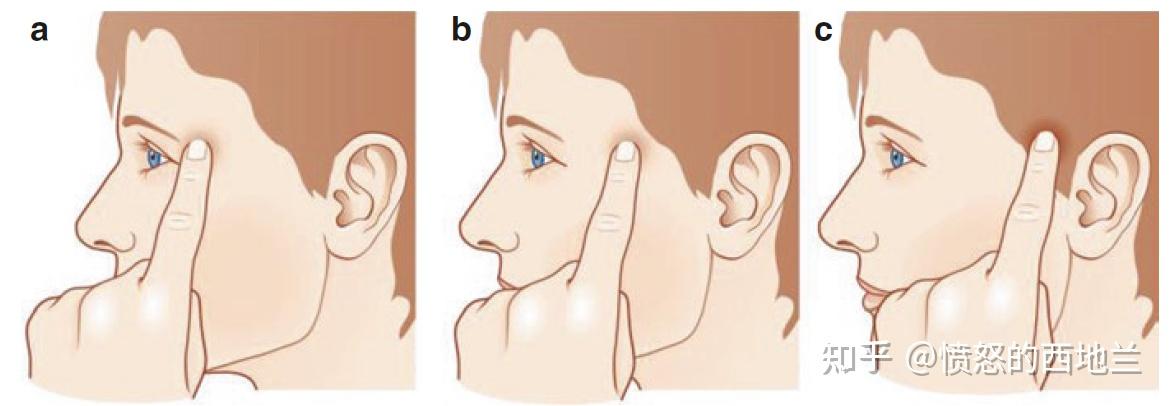 什么是耳颞神经相关性偏头痛?