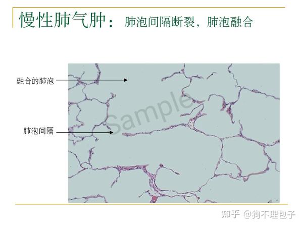 慢性肺气肿