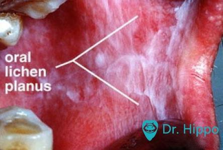 口腔扁平苔藓的诊治