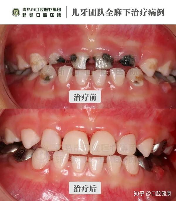 儿童蛀牙更多发生在这颗牙上!——六龄齿
