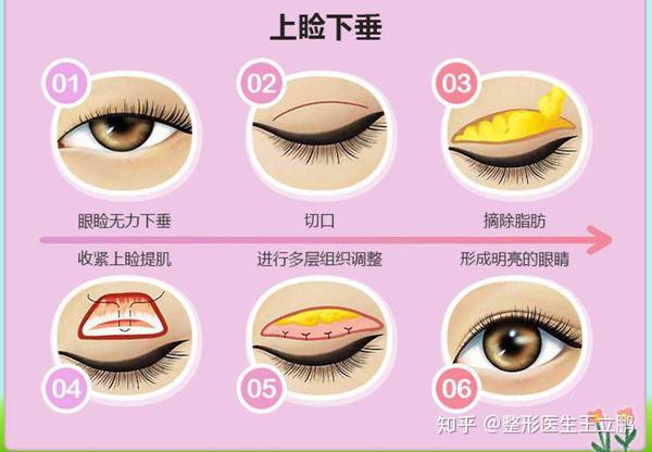 打开上眼睑的组织,通过分离和去除部分组织再缝合,将上睑提肌缩短缩