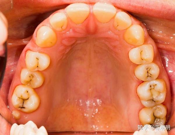 成都看牙医生牙齿上刷不掉的黑线是什么是蛀牙吗