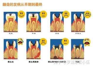 龋齿发展到最后阶段是牙冠完全被龋蚀所破坏