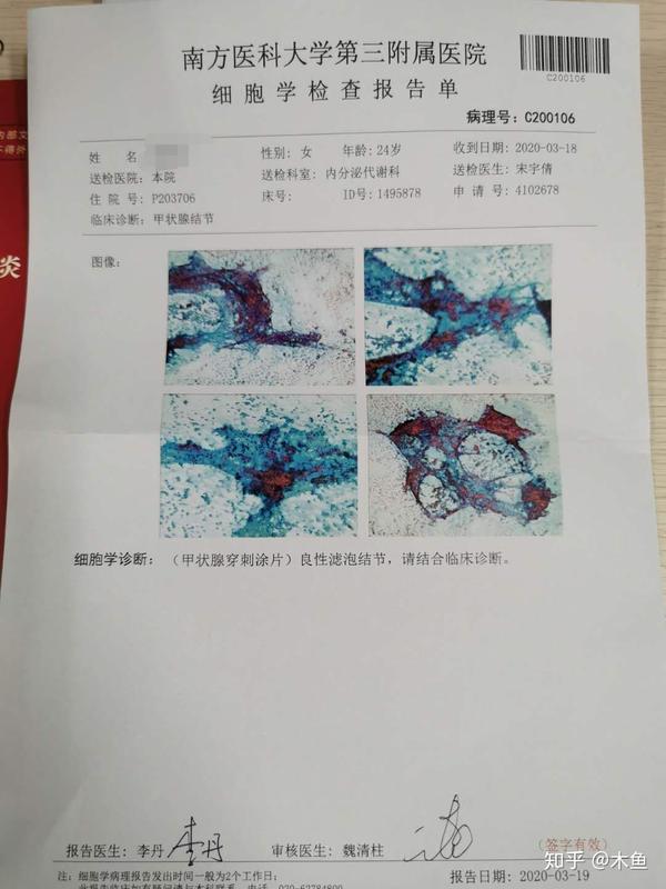 甲状腺结节4级穿刺过程
