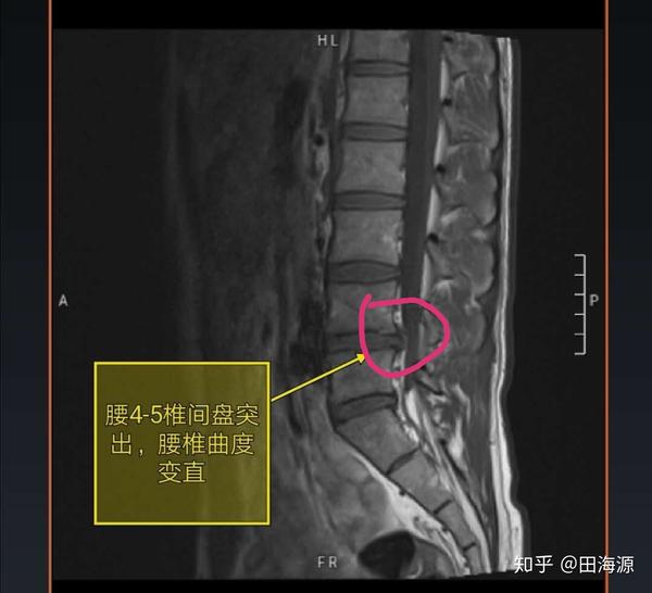 腰椎间盘突出恶化史