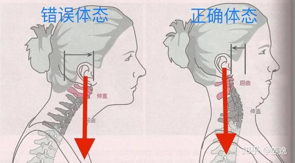 颈椎引起的偏头怎么办