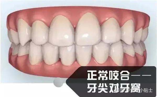 正常咬合:上排牙齿的窝,对下排牙齿的尖,上排牙齿在前,上排牙齿盖住下