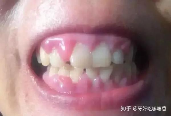 肥大增生的牙龈