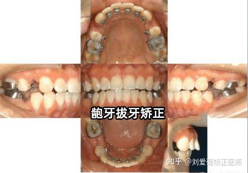 (上下前牙没有咬合或咬合过少)的患者,多数情况下是需要拔牙矫正的